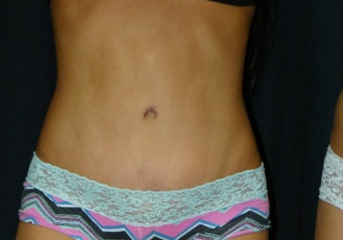 Can Cosmetic Surgery Remove Stretch Marks?